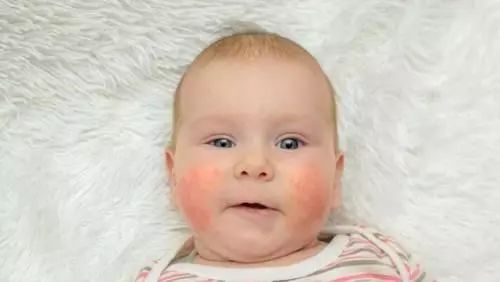 宝宝“湿疹”反复发作治不好?小心是特应性皮炎惹的祸!