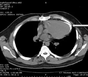 打针输液时空气进入了血管，我是不是要死了？