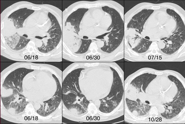 肺实变典型影像,侵入性肺曲霉病和侵袭性肺曲霉病