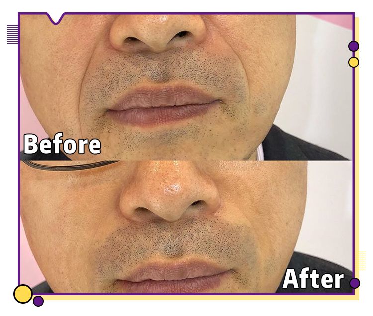 一分钟提拉紧致去除眼袋皱纹,修眼袋祛皱纹神器