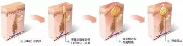 额头反复长痘是什么原因引起的,为什么老是长痘反复