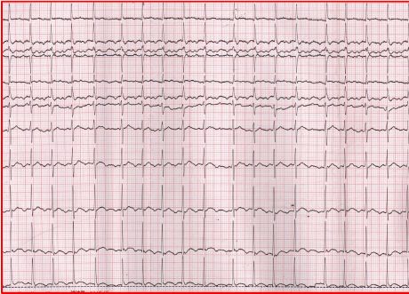 做完消融手术后胸闷憋气,射频消融术后胸闷气短是怎么回事