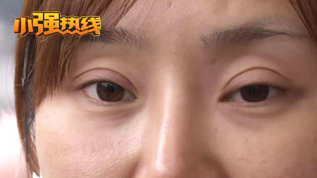 做了双眼皮之后感觉自己变老了,做完双眼皮感觉自己变老了