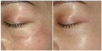 激光美容祛疤的真实性,激光美容真的靠谱吗