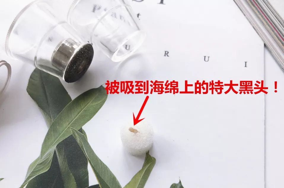 草莓鼻救星怎么治疗,草莓鼻去黑头神器视频