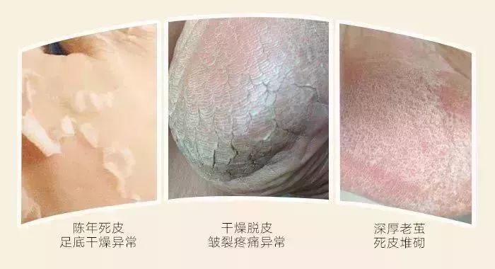 脚后跟干裂修复霜去死皮,脚干裂脱皮修复霜