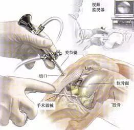 半月板损伤做完微创后几天康复,半月板损伤100天了如何恢复