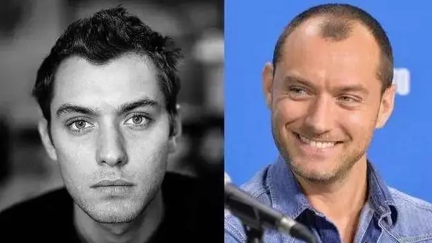 疯狂掉头发发际线后移,疯狂掉头发头发变得稀疏