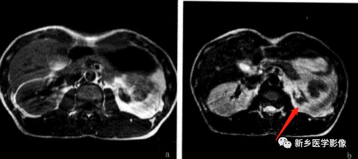 临床常见6种肾脏变异，鉴别诊断要点一览