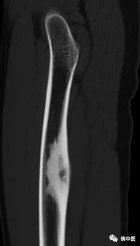 「安心过年」微创手术直击病灶！两骨瘤患者慕名而来，携健康回家