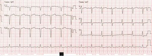 心衰治疗金三角,心衰的金三角治疗是指什么