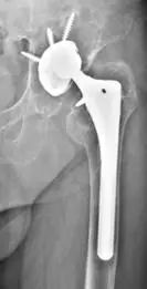 「筋骨堂」人工髋关节并非一劳永逸