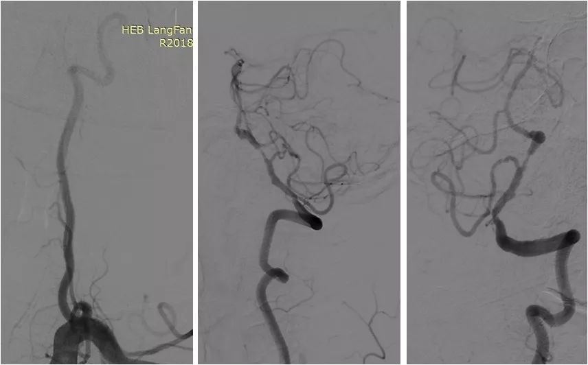 椎动脉v4段血管瘤介入治疗,臭氧治疗左侧v4段椎动脉狭窄