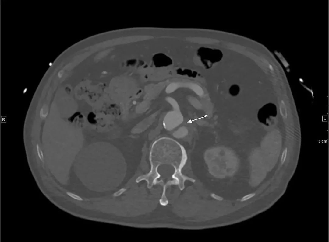 心冠动脉夹层能治愈吗,夹层动脉血管破裂症状
