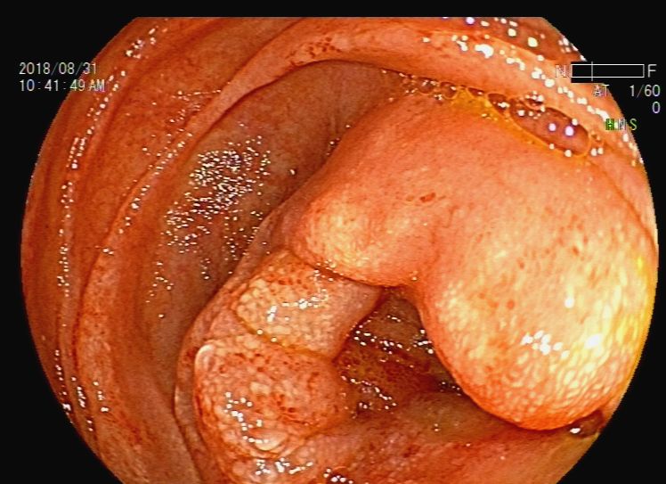 消化道支架置入术,消化道梗阻支架怎么放
