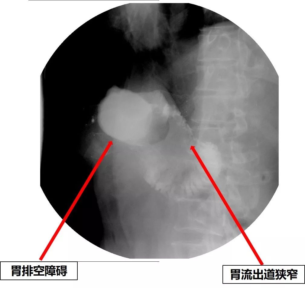 消化道支架置入术,消化道梗阻支架怎么放