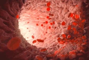 洗血疗法降血脂吗,血液净化揭秘