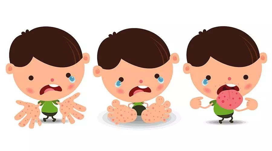 夏季手足口病的预防小知识,手足口水痘注意事项