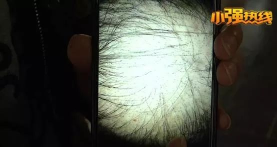 头发睫毛眉毛全部掉光能不能治好,头发睫毛眉毛全部掉光有没有案例