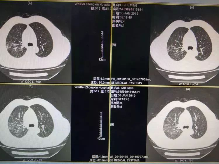 渭北中心医院呼吸内科成功救治一例重症肺炎患者