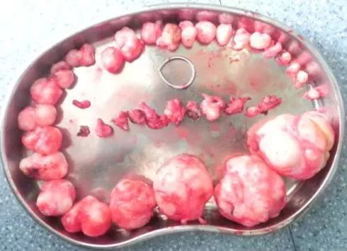 被“它”折磨的女性越来越多！医生看到她子宫里的东西——彻底惊呆了！