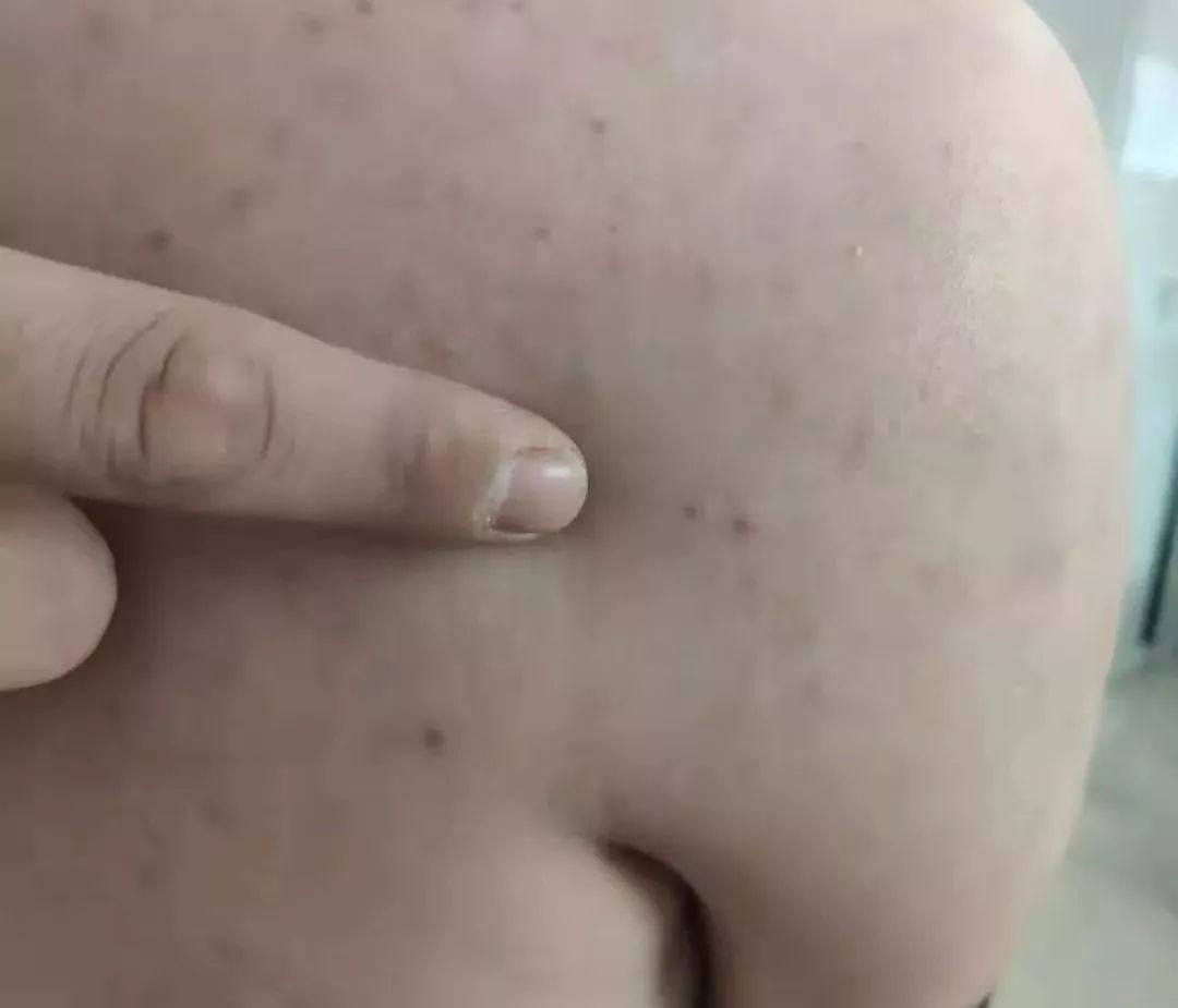 怎样帮中风的人做康复训练视频,如何解决中风后遗症问题