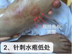 热水袋烧伤,热水袋烧伤起泡怎么处理