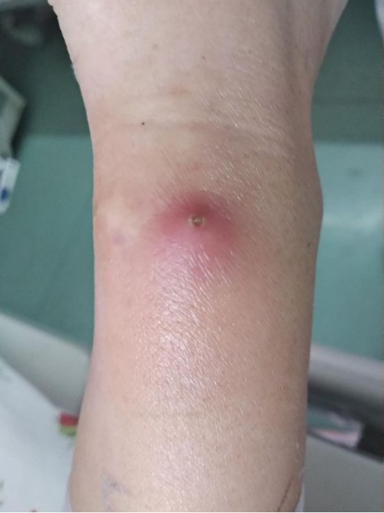 留置针细菌感染了会怎么样,留置针拔了漏药水