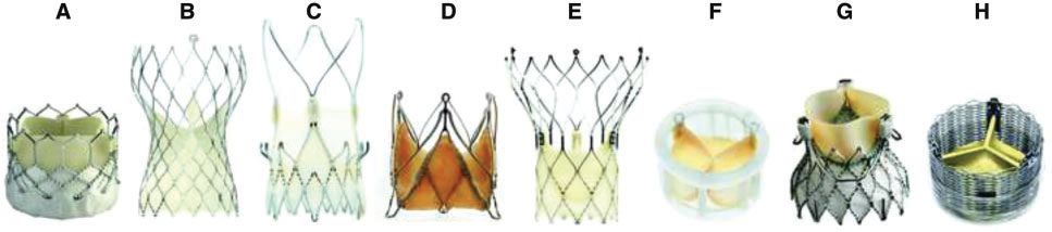 经导管瓣膜修复术费用,经导管瓣膜植入术风险
