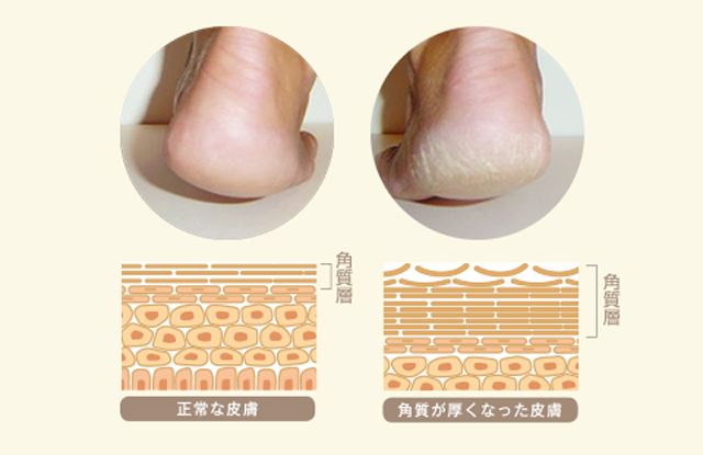 干裂的脚怎么修,干裂的脚后跟有救了