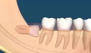 有一种痛叫做拔智齿的痛,有种疼叫智齿疼6种情况果断拔掉