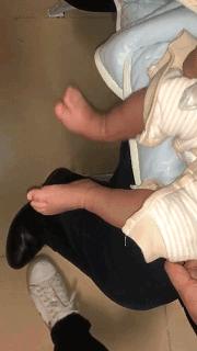 刚出生就要打石膏?硬核医生手工打造矫形器治疗足外翻