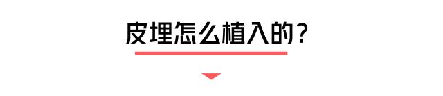 小小一根棒，比套套和上环安全，避孕率超高却少有人知道