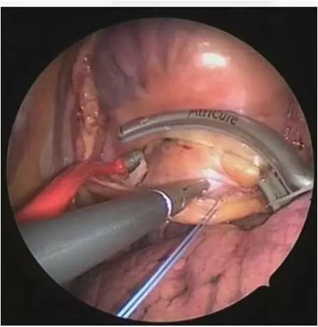 专家谈房颤怎么治疗,专家讲房颤治疗方法