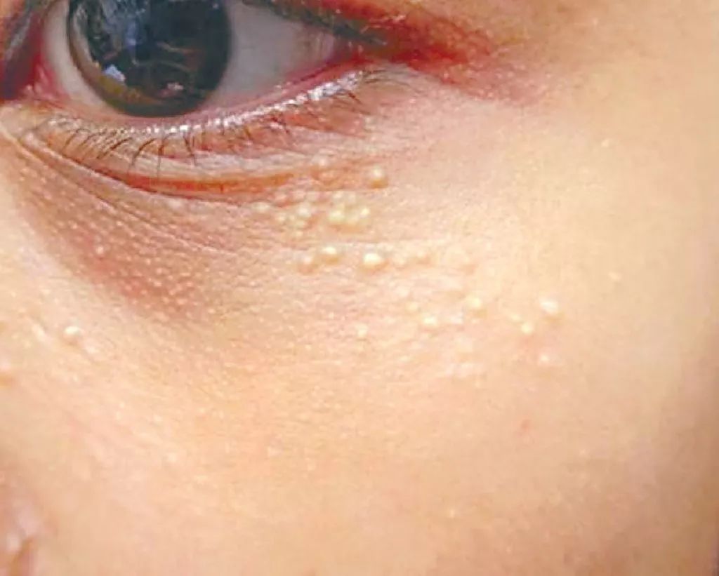 涂眼霜会导致脂肪粒？No