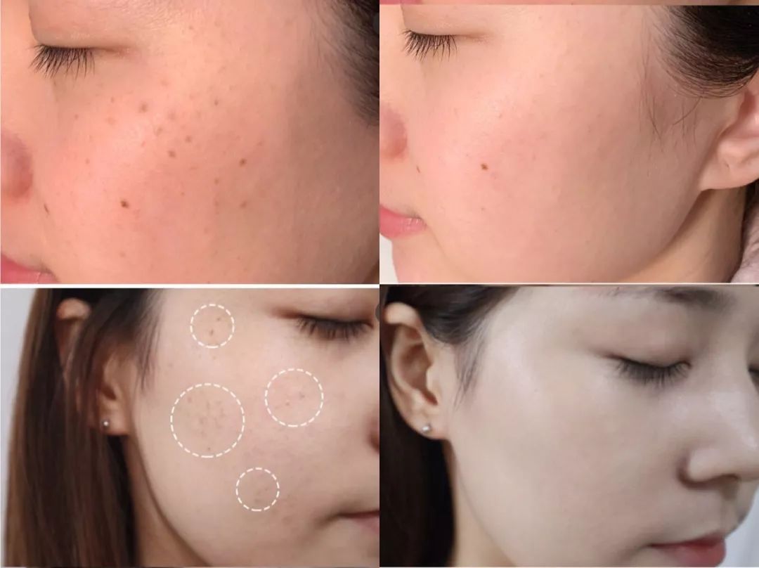 祛斑美白补水祛皱祛痘,祛斑祛痘美白改善暗沉