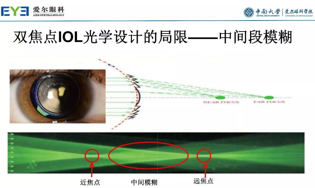 大师讲堂预告丨连续视程白内障手术治疗散光的关键要点-公式选择和手术松解要点