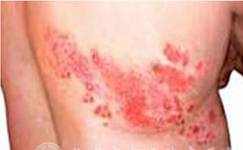 蛇盘疮带状疱疹可以吃病毒灵吗 (蛇缠头带状疱疹)