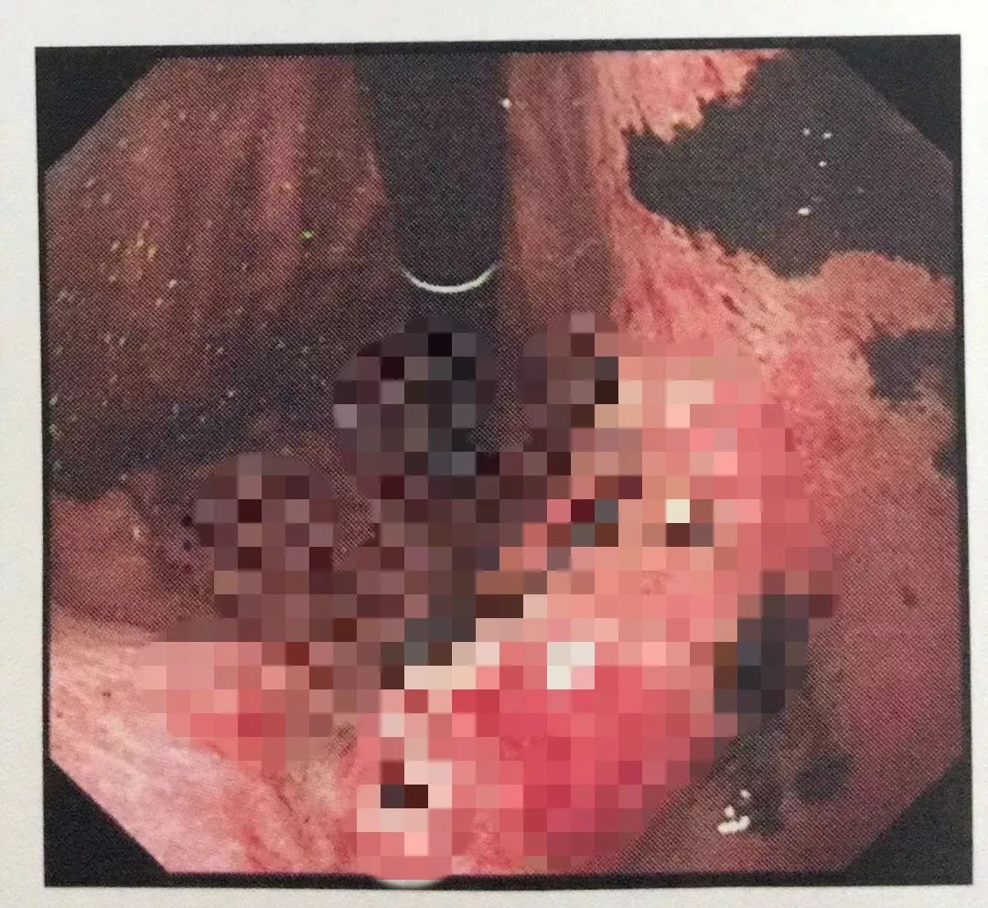 发现男友与前任联系，女子连吃5大包辣条，结果…