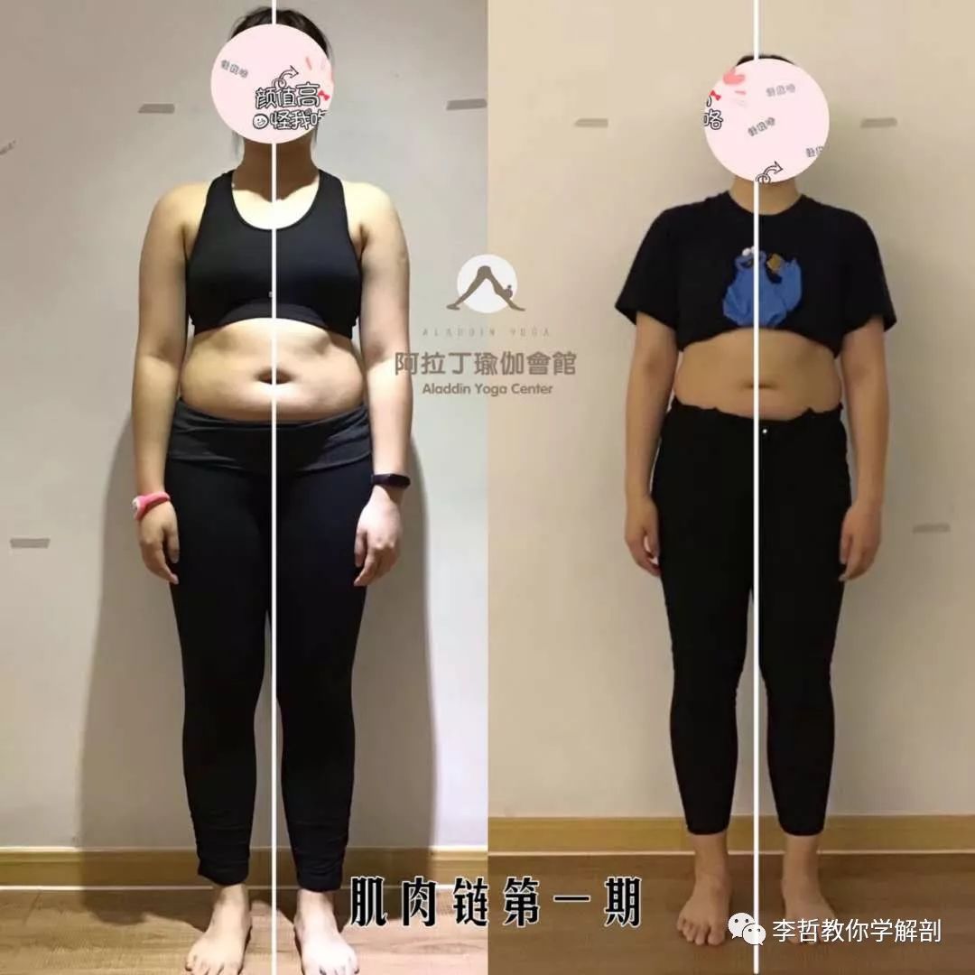 腰间盘突出脊柱侧弯康复训练,螺旋肌肉链训练治疗腰椎间盘突出