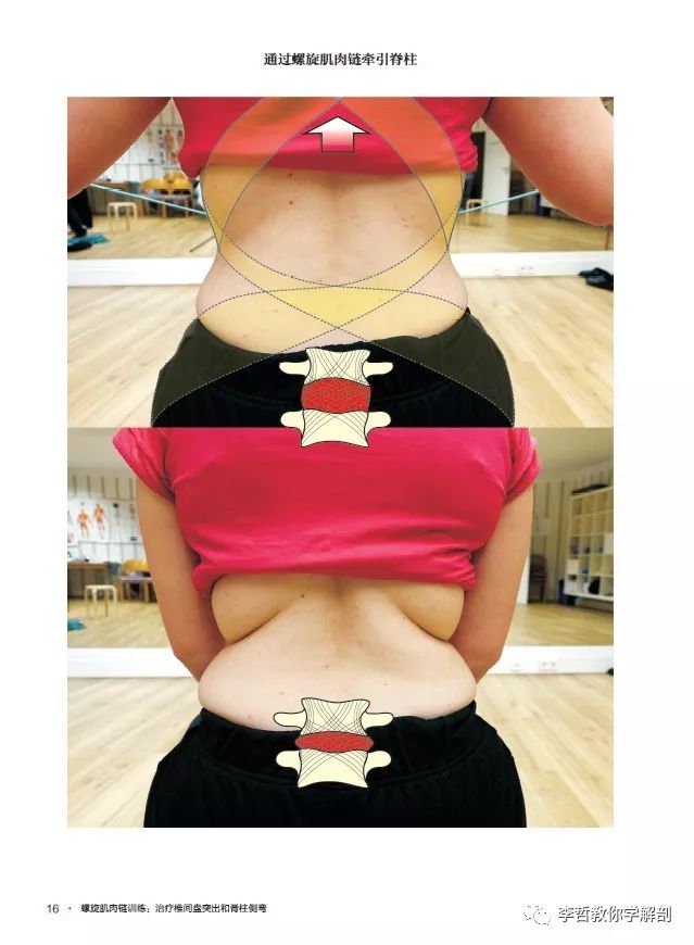 腰间盘突出脊柱侧弯康复训练,螺旋肌肉链训练治疗腰椎间盘突出
