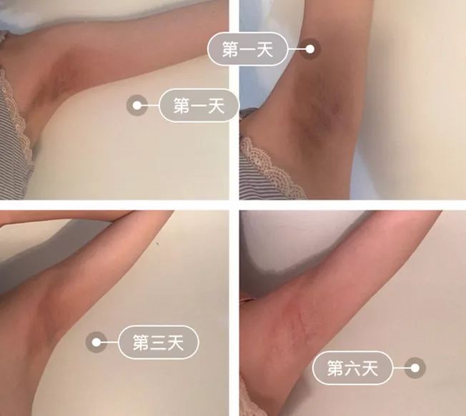 可美金箔祛痘螨虫皂,除螨皂能祛螨虫吗