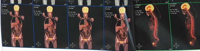 泰国回来得了白血病,泰国旅游回国后确诊淋巴瘤
