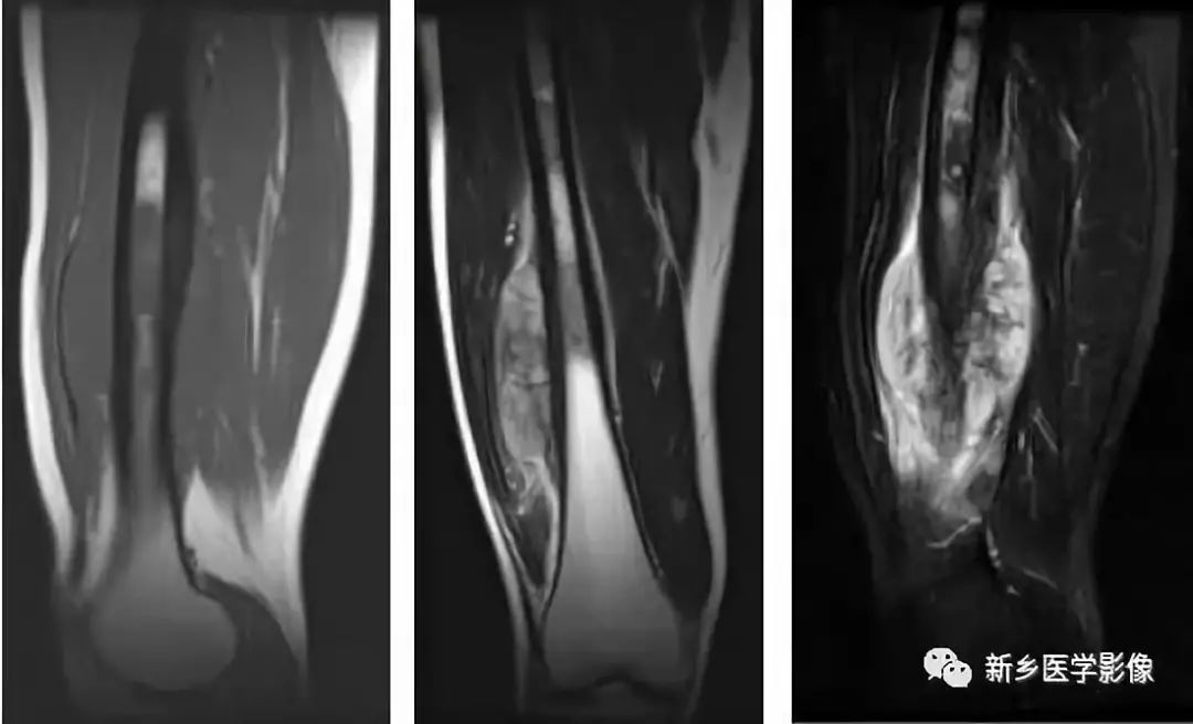 骨骼疾病怎么调理最有效,骨骼坏死最佳治疗方法