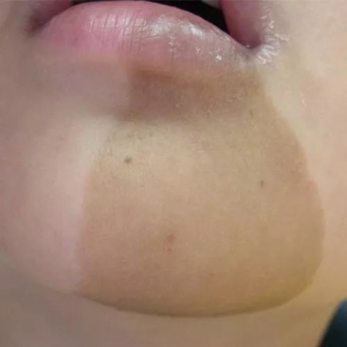 孕妇有咖啡斑会遗传给宝宝吗,孕妇喝咖啡胎儿会长斑吗