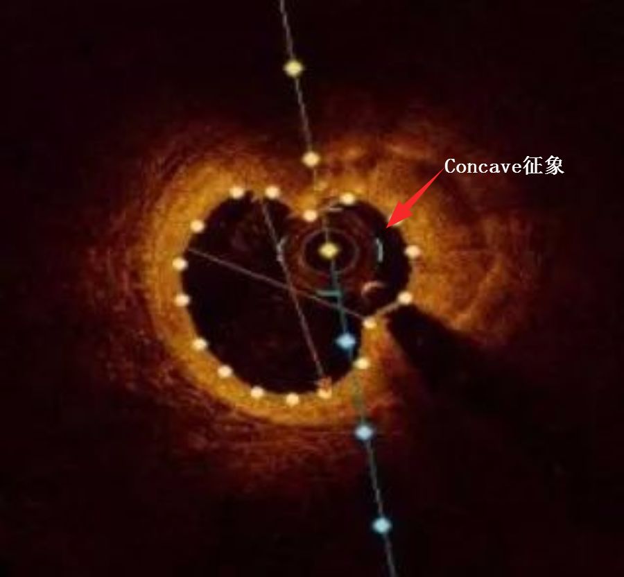 CIT2019｜李妍教授：OCT指导钙化病变，这些精髓要知道