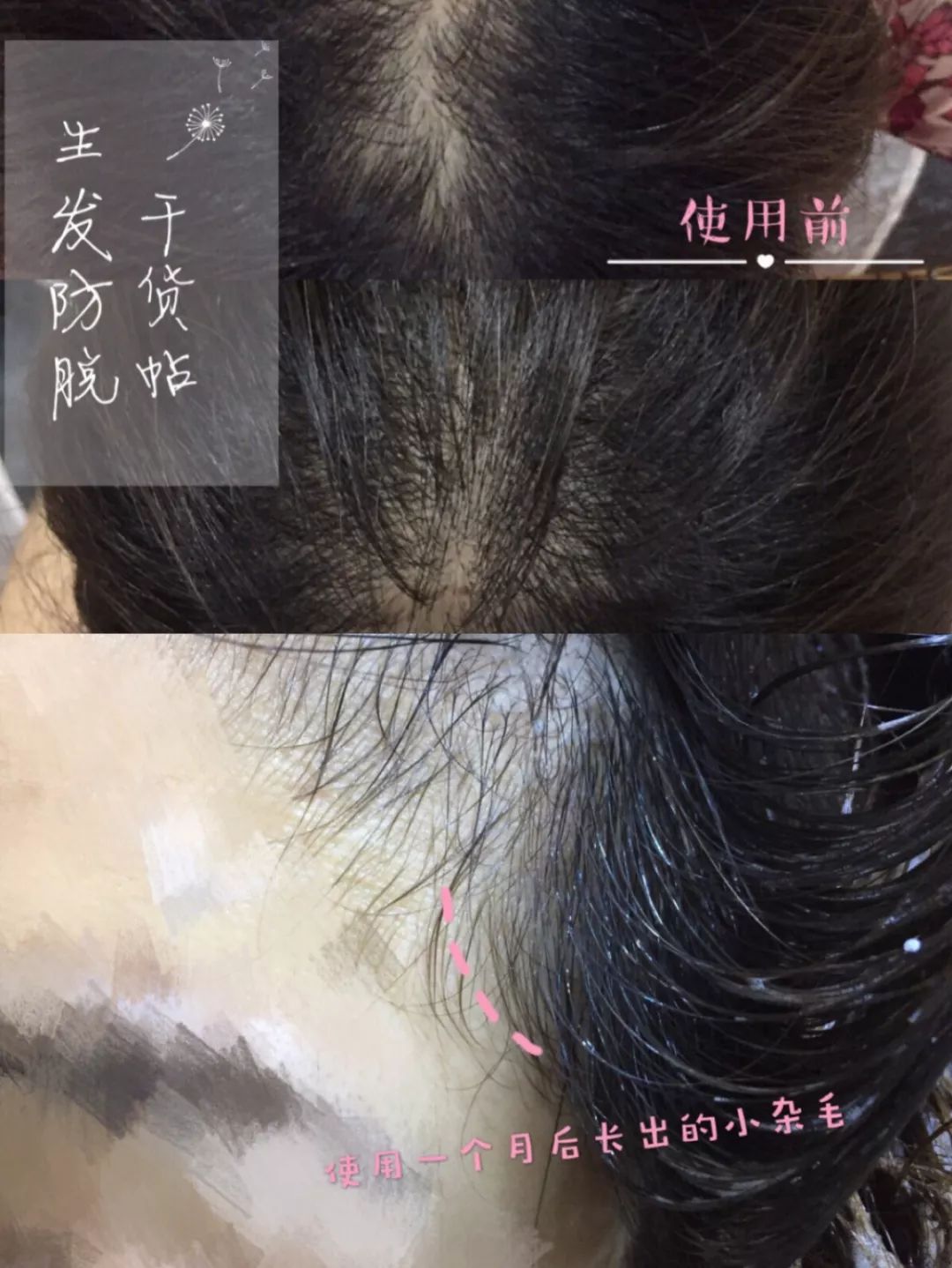 生发长头发神器,脱发生发最新科技