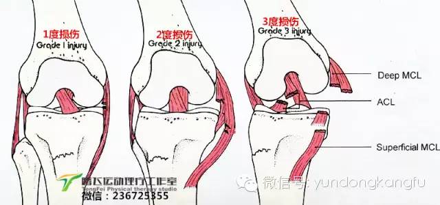 膝内侧副韧带损伤吃什么药,膝韧带损伤预防与康复训练