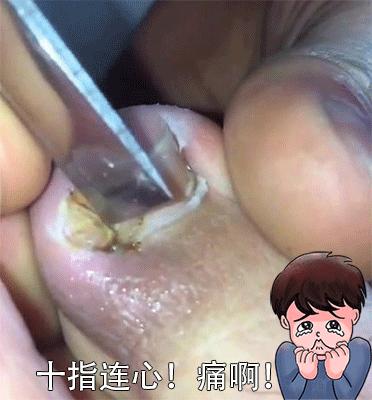 趾甲扎进肉里了，一碰就痛？用它一贴，1分钟止痛，趾甲往外长，再也不扎痛了！