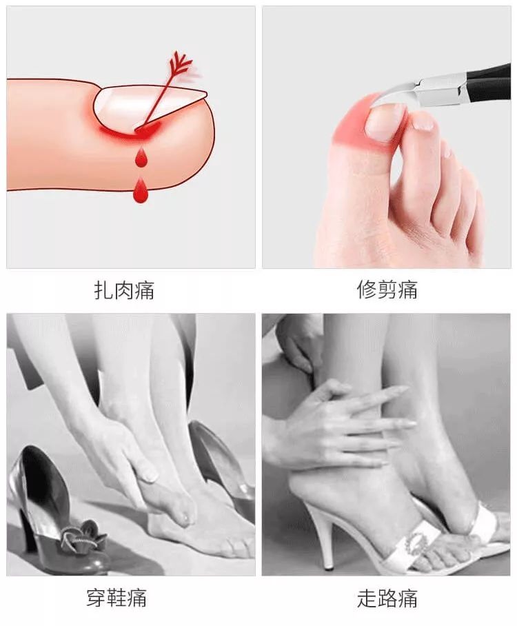 趾甲扎进肉里了，一碰就痛？用它一贴，1分钟止痛，趾甲往外长，再也不扎痛了！